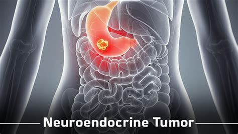 Neuroendocrine Tumor - Causes, Symptoms, Diagnosis, Prognosis, Treatment