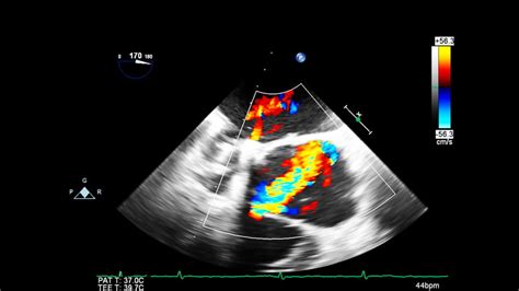 Use of Ultrasound in Cardiac Arrest | EM Ultrasound Section