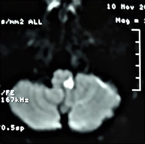 Diffusion weighted imaging showing diffusion restriction suggestive of ...