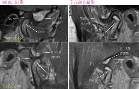 TMJ diaries: TMJ MRI scans