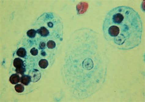 Entamoeba Histolytica Symptoms