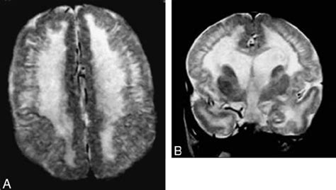 Lissencephaly Mri