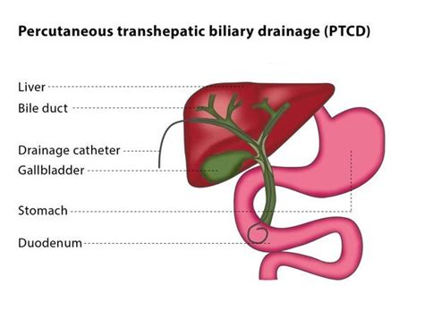 Biliary procedures – CIRSE