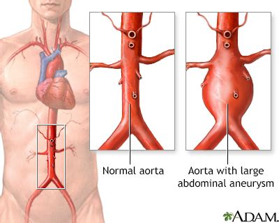 Abdominal Aortic Aneurysm (AAA) Symptoms, Doctors, Treatments, Advances ...