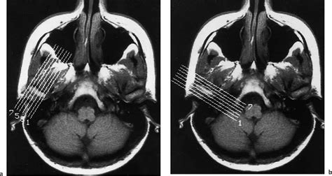 Temporomandibular Joint | Radiology Key