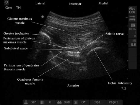 Ischial Bursitis Ultrasound