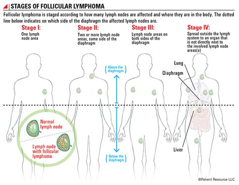 Follicular Lymphoma Staging