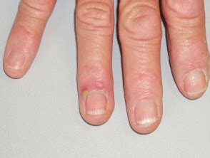 Paronychia (nail fold infection): Causes, Images, treatment, and more ...