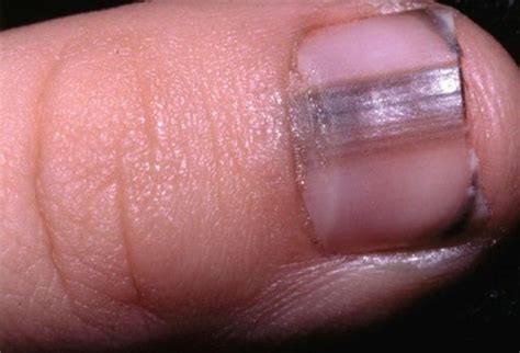 What causes fingernail problems? – What causes this?