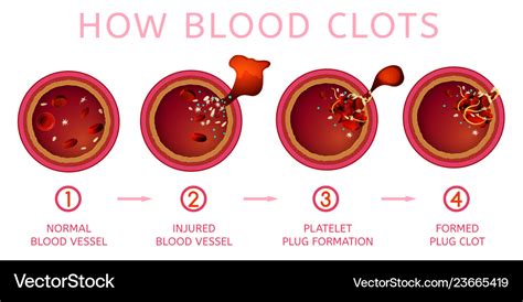 Blood clotting process Royalty Free Vector Image