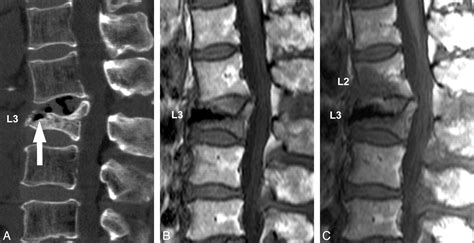 Subsequent Fracture after Percutaneous Vertebroplasty Can Be Predicted ...