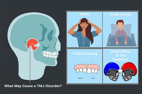 TMJ (Temporomandibular Joint) Disorders: Symptoms And More, 58% OFF