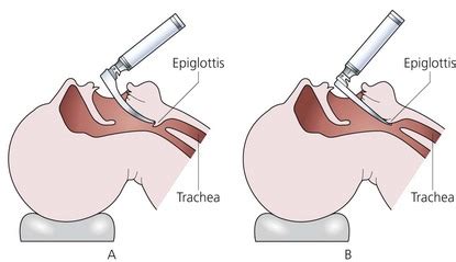 Laryngoscopes and tracheal intubation equipment | Clinical Gate