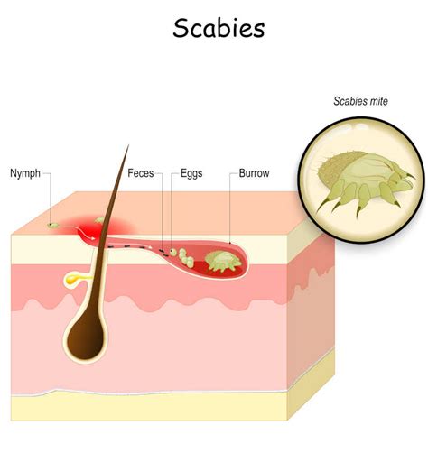 Dog Scabies Is Contagious to Humans: Symptoms & Prevention