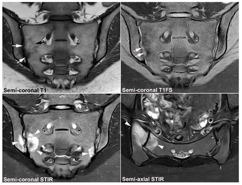 JCM | Free Full-Text | Diagnostics of Sacroiliac Joint Differentials to ...