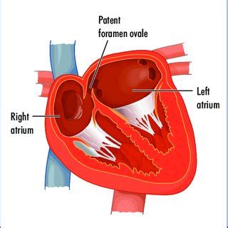 Anatomy of the patent foramen ovale. | Download Scientific Diagram