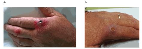 Cutaneous anthrax - Pictures