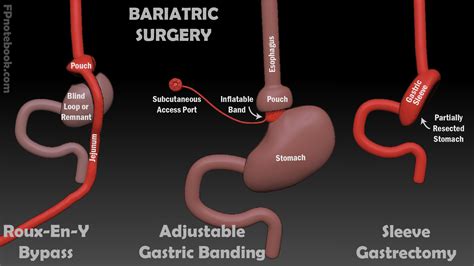 Adjustable Gastric Banding