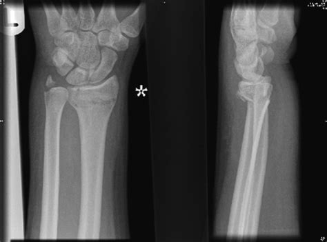 Ulnar Styloid Fracture Treatment