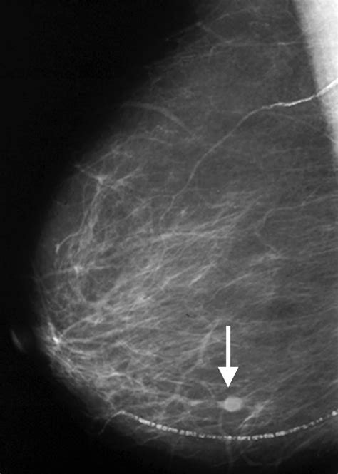 Mammograms Showing Breast Cancer