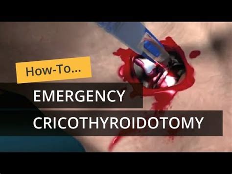 Emergency Cricothyroidotomy using CricKey - YouTube