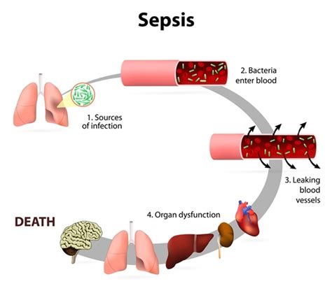 Sepsis (Septicemia) Treatment