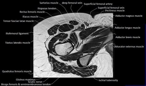 Pelvis Muscles Mri Anatomy - MRI anatomy of hip joint | free MRI axial ...