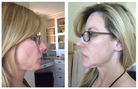 Botox for Jowls, Ladies! (need I say more?) - Beauty Black Book | Botox ...