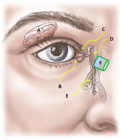 Lacrimal Obstruction - Peter A.D. Rubin, M.D.