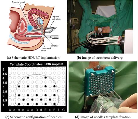 [PDF] HDR brachytherapy as monotherapy for low risk prostate cancer ...