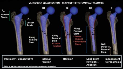 Periprosthetic Femoral Fractures in the Emergency Department: What the ...