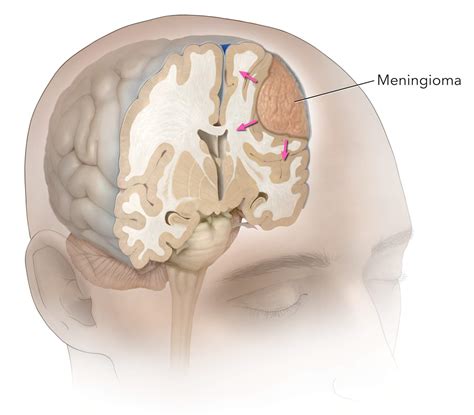 Natural History of Meningioma | Expert Surgeon | Aaron Cohen-Gadol, MD