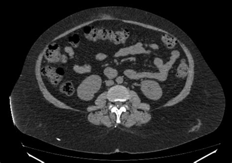 Lumboperitoneal shunt | Image | Radiopaedia.org