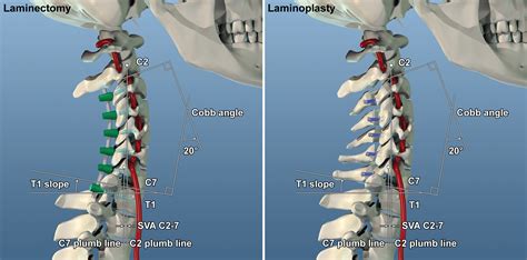 Laminoplasty versus laminectomy with posterior spinal fusion for ...