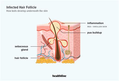 Recurring Boils: Causes and Treatment