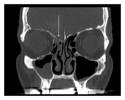 Ethmoid Sinus Ct Scan