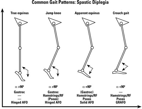 Gait patterns and management algorithm in spastic hemiplegia [3 ...