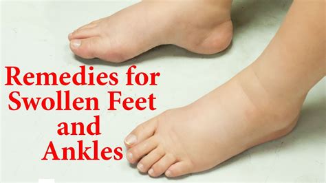 Home Remedies For Swollen Feet