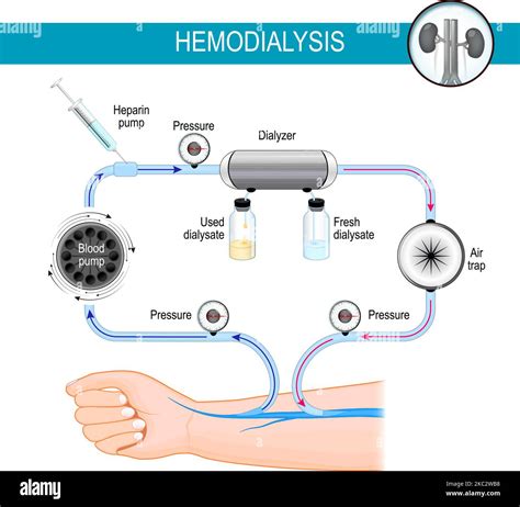 The principle of Hemodialysis machine. Dialysis process. haemodialysis ...