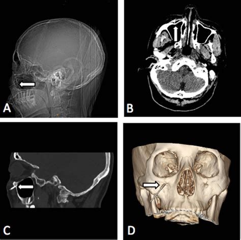 Operative procedure of puncturing the infraorbital foramen. (A ...