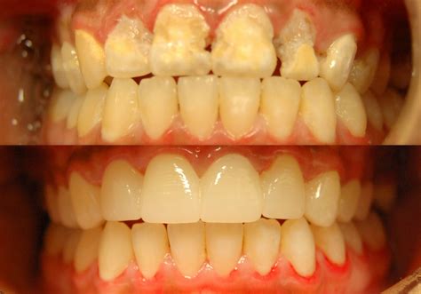 Porcelain Crowns Archives - Prestige Family Dentistry