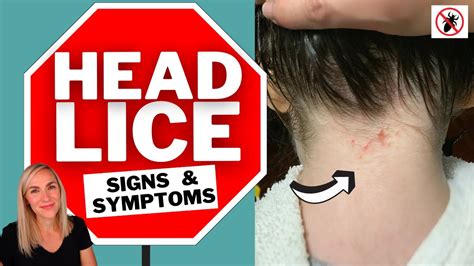 17 Lice Symptoms with Pictures: Signs That You Have Head Lice - My Lice ...