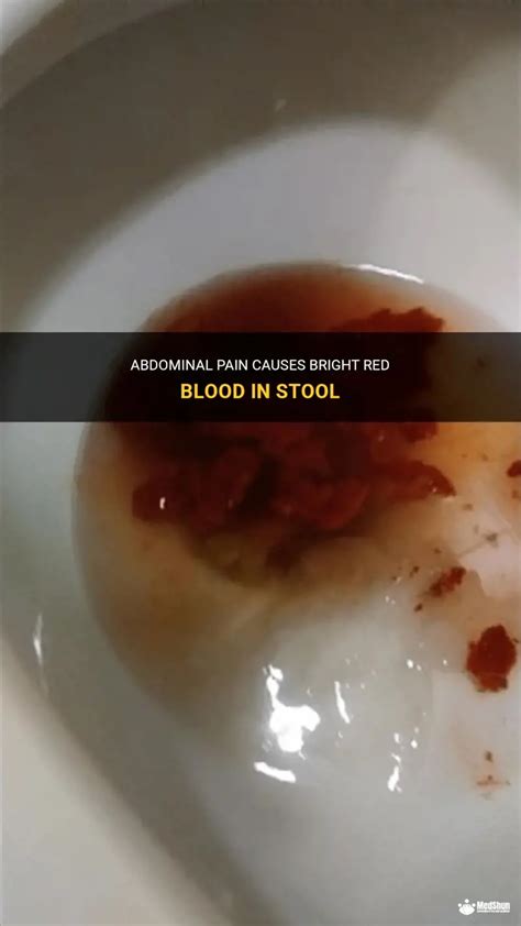 Abdominal Pain Causes Bright Red Blood In Stool | MedShun