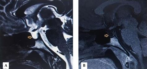 MRI Brain -Yellow arrow showing empty sella (A) T2 weighted, (B) T1 ...