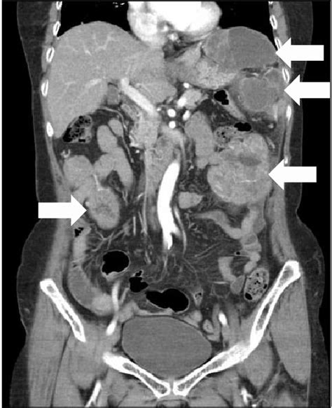 CT scan of the abdomen shows multiple lobulated solid masses with ...