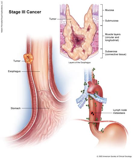 esophagus cancer stages