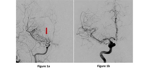 Moyamoya Disease | Baylor Medicine