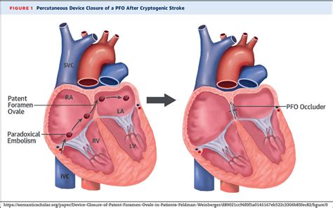 Patent Foramen Ovale | Hartford HealthCare | CT