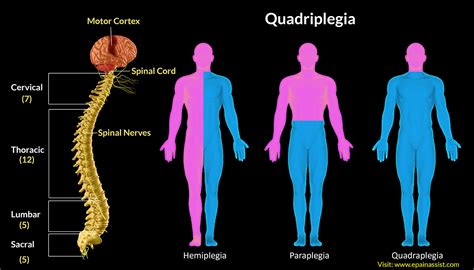 HEMIPLEGIA AND HOMEOPATHY - EXPERT HOMEOPATHY