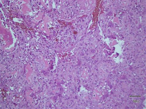 Osteoblastoma Histology